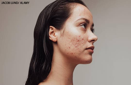 Woman with persistent acne