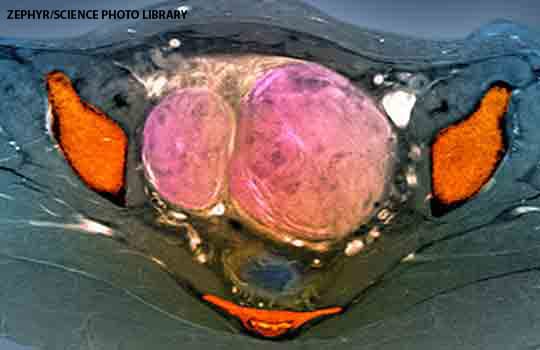 Uterine fibroids