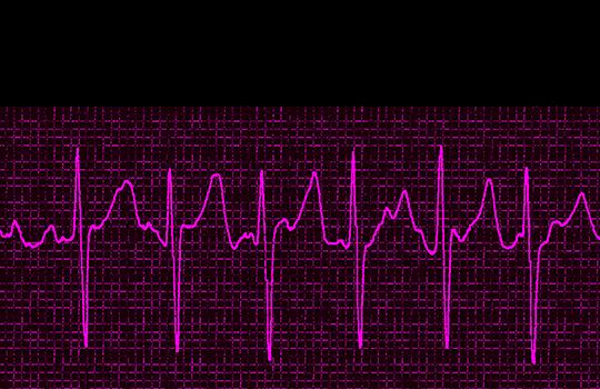 Atrial fibrillation