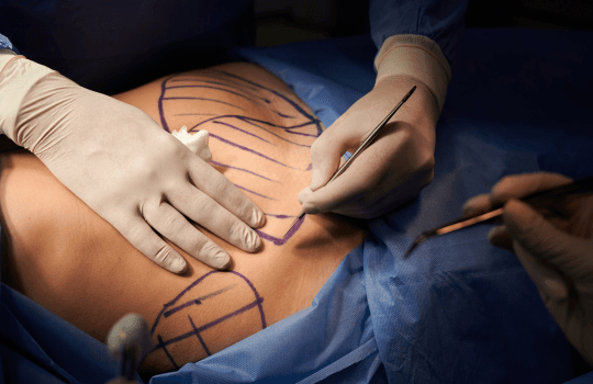 Tummy tuck surgery