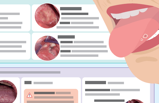 Oral ulcers