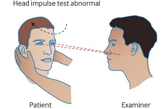 An abnormal head impulse test