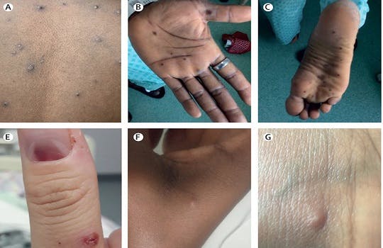 Features of monkeypox